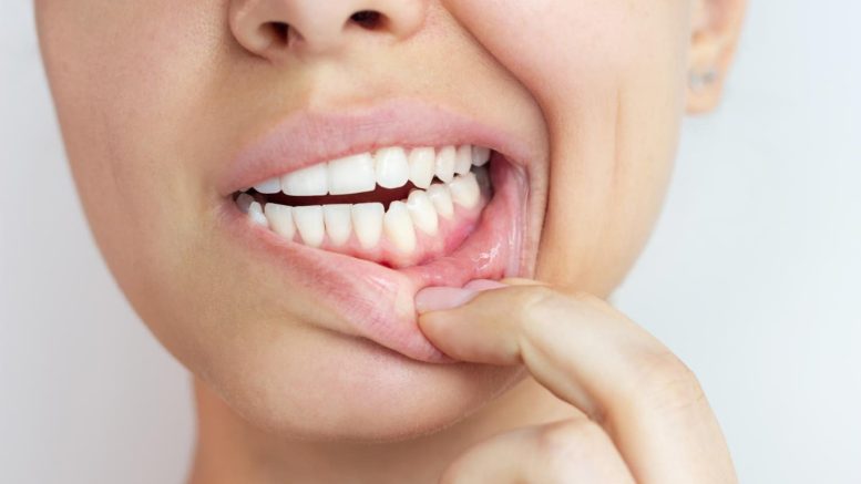 consecuencias del mal cuidado de las encías